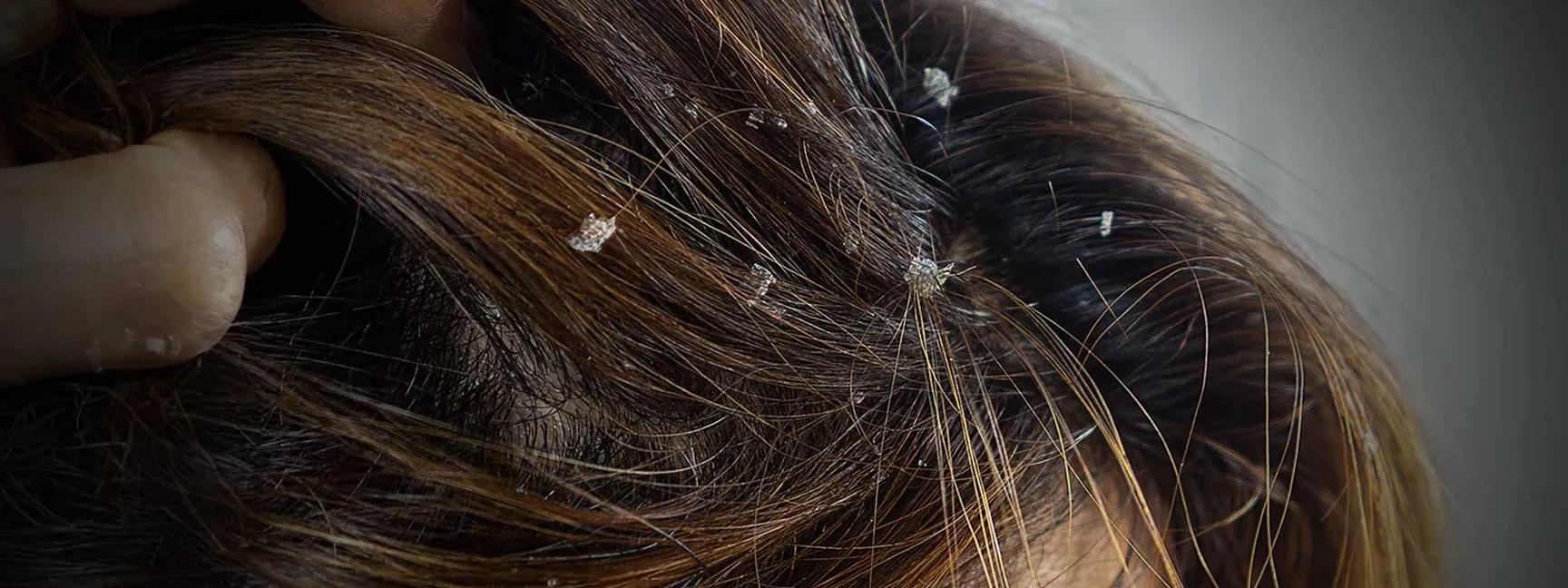 7 Best Oily Flaky Scalp Solutions You Need Now