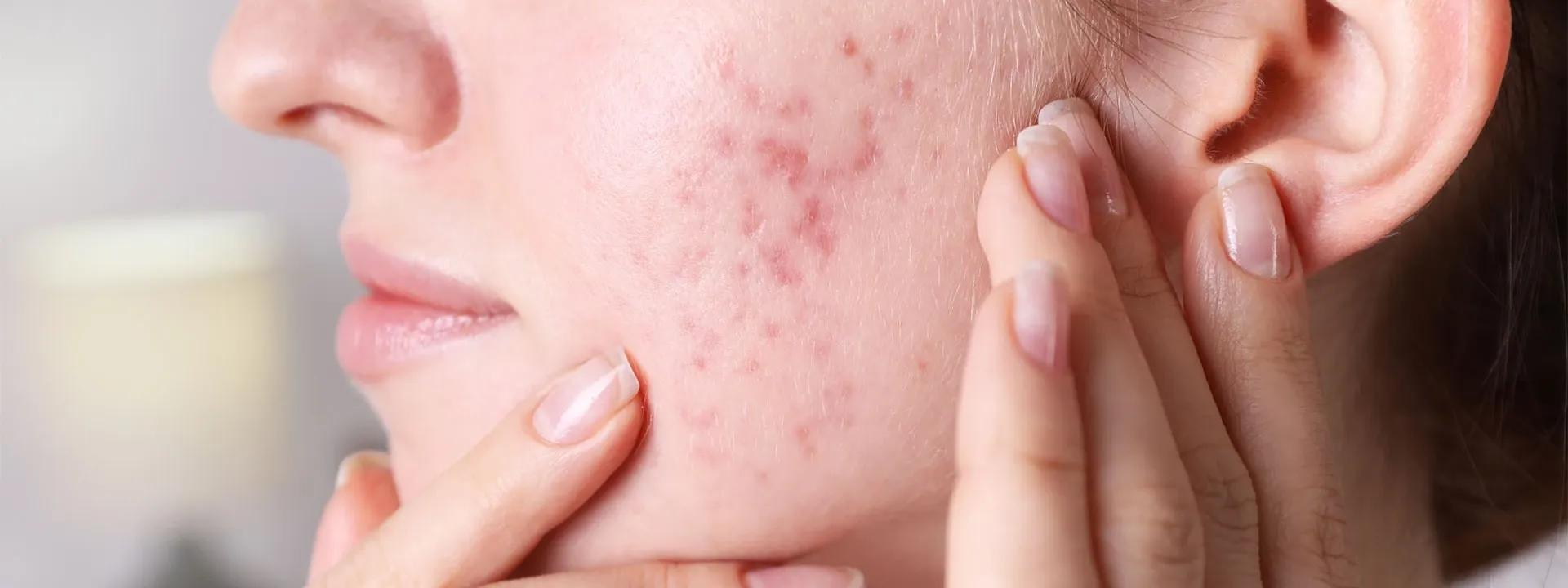 How to Use Tranexamic Acid for Post Acne Pigmentation